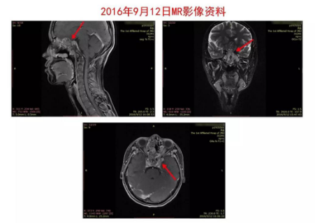 质子重离子,出国就医,海外医疗