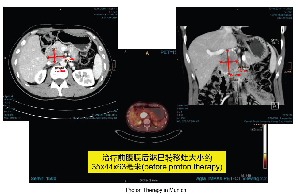 腹膜后淋巴转移