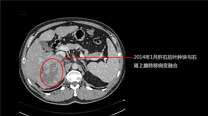 质子治疗肝癌