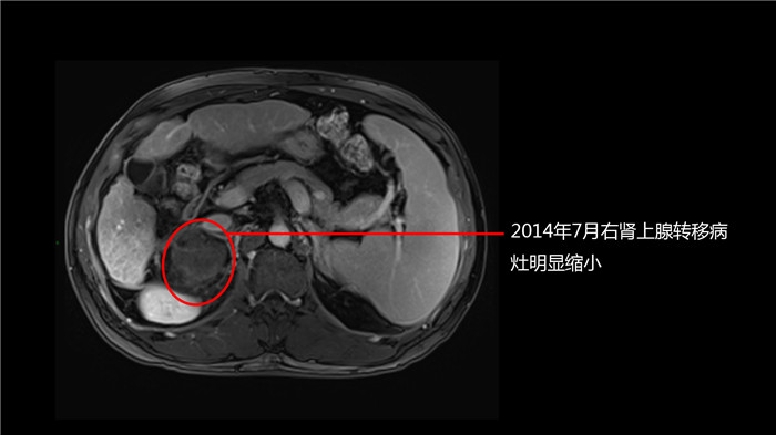 质子治疗肝癌